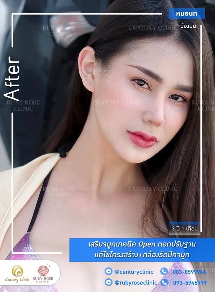 รีวิว เสริมจมูก #467 , Century Clinic Thailand Century-รีวิว-เสริมจมูก 1#467