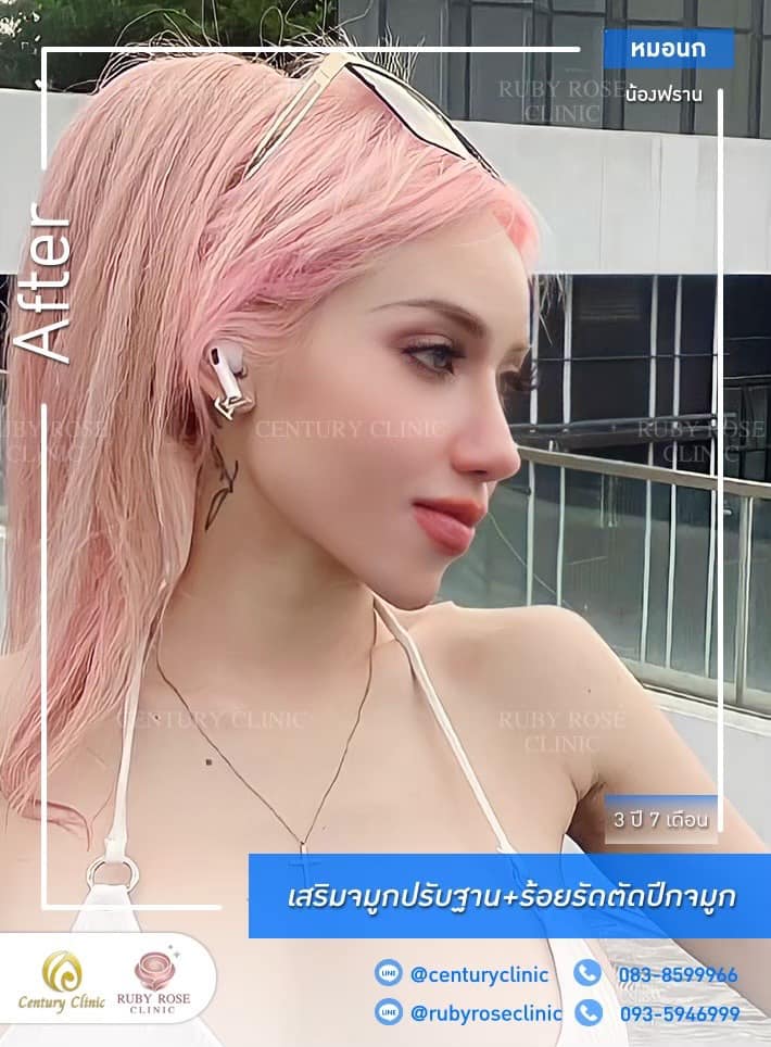 Century-รีวิว-เสริมจมูก 1#471