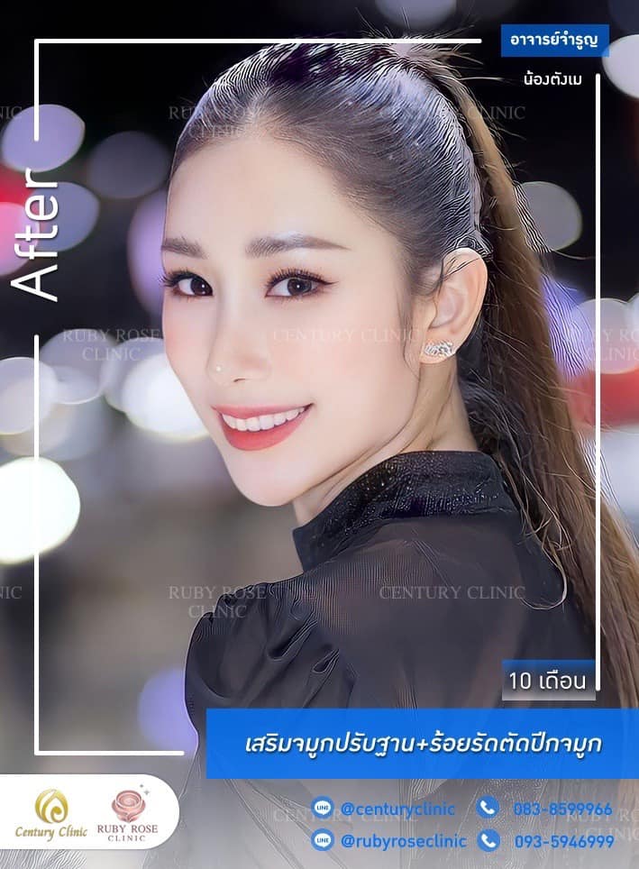 Century-รีวิว-เสริมจมูก 1#479