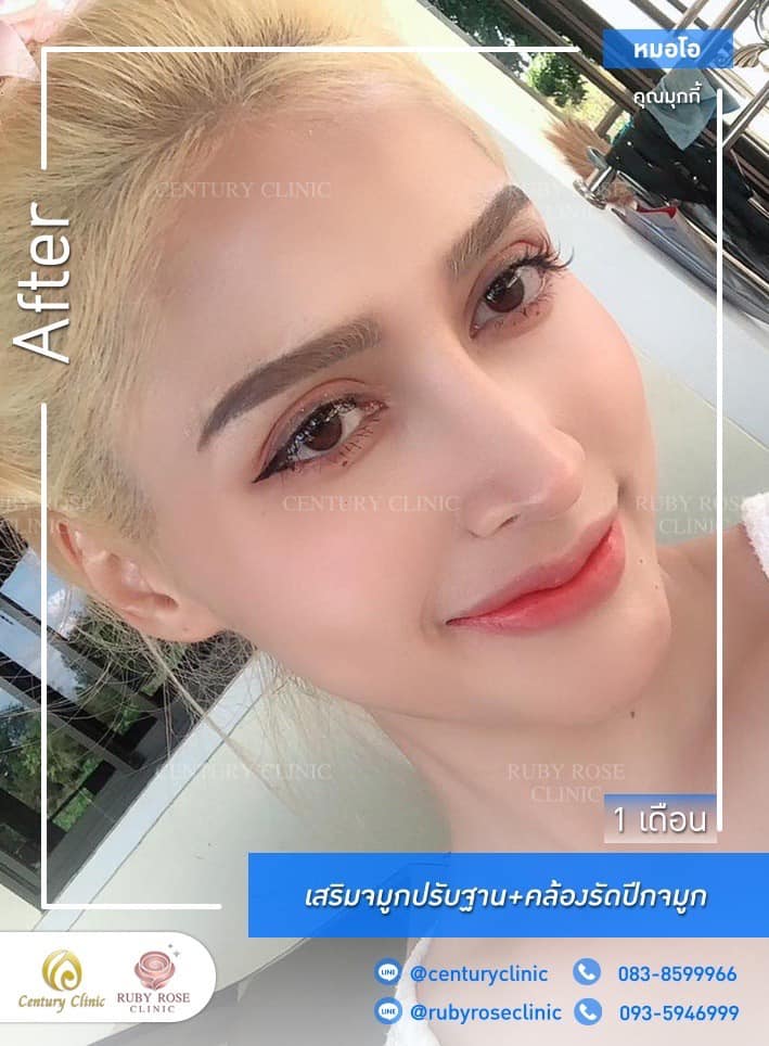 รีวิว เสริมจมูก #482 , Century Clinic Thailand Century-รีวิว-เสริมจมูก 1#482