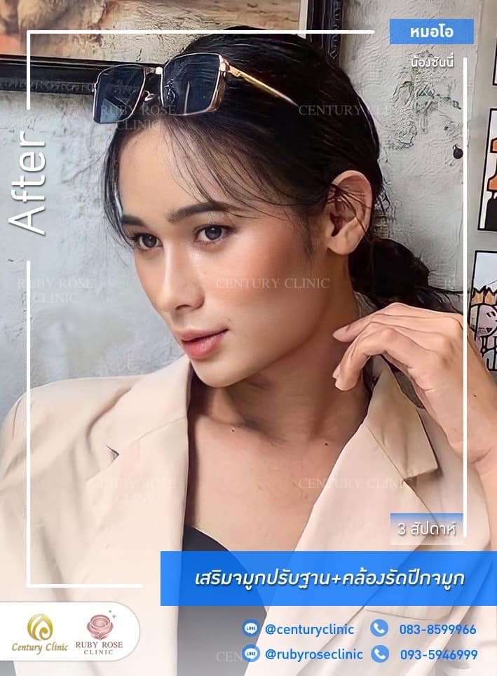 Century-รีวิว-เสริมจมูก 1#501