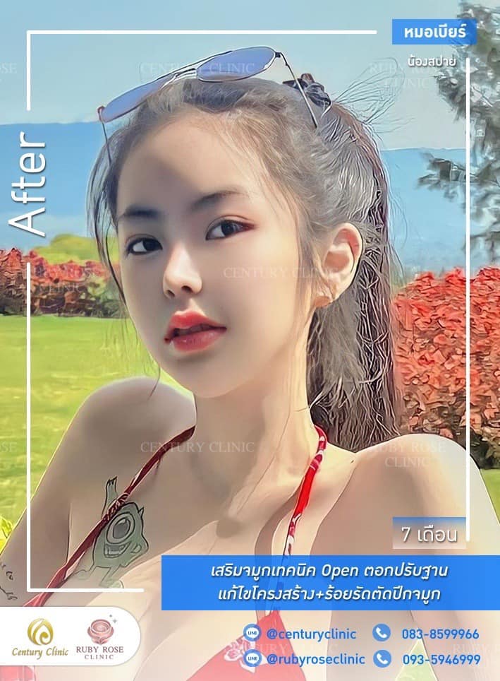 Century-รีวิว-เสริมจมูก 1#502