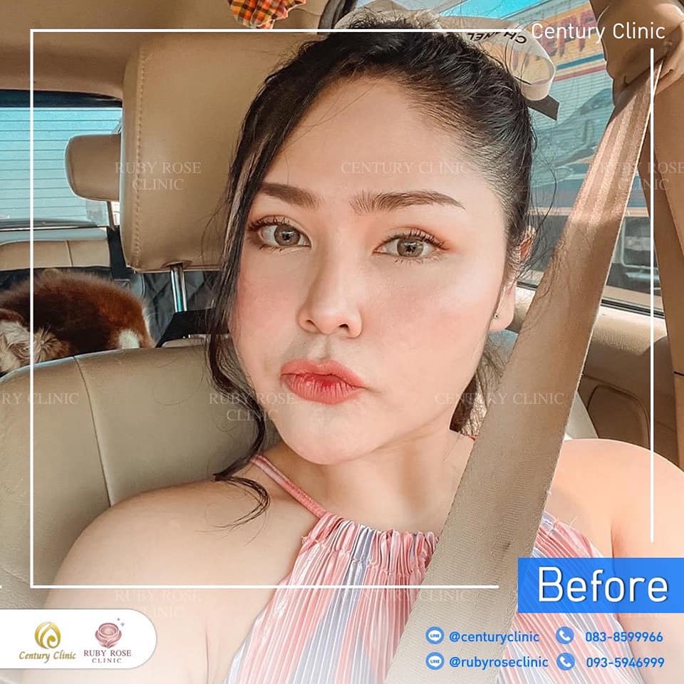 รีวิว เสริมจมูก #504 , Century Clinic Thailand Century-รีวิว-เสริมจมูก 1#504