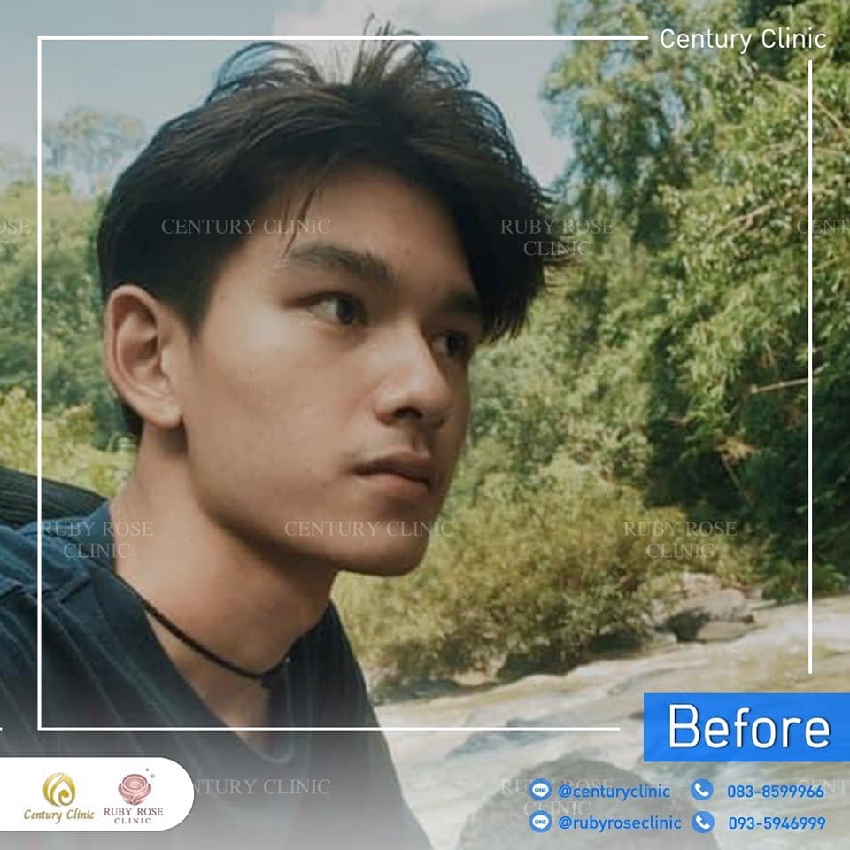 Century-รีวิว-เสริมจมูก 2#426