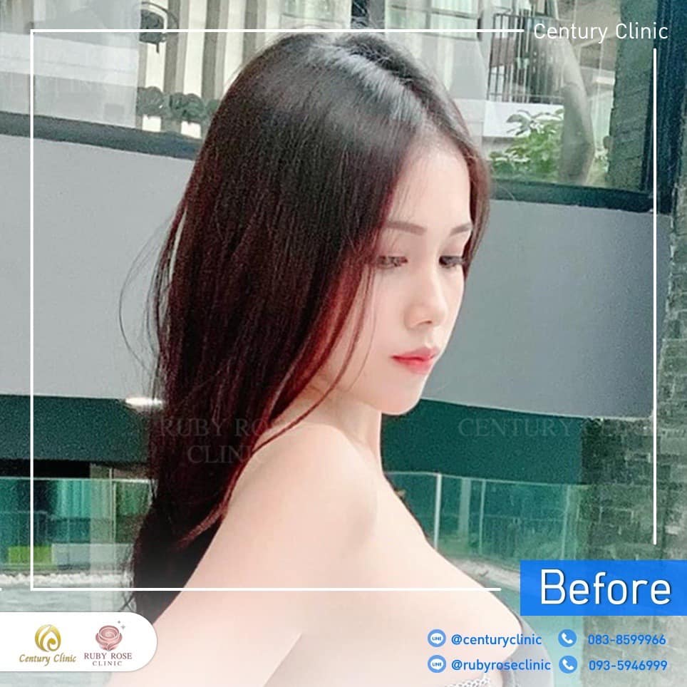 รีวิว เสริมจมูก #462 , Century Clinic Thailand Century-รีวิว-เสริมจมูก 2#462