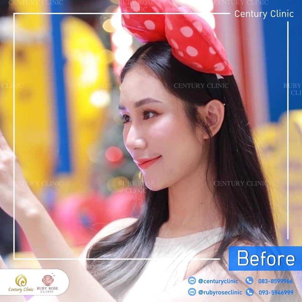 Century-รีวิว-เสริมจมูก 2#479
