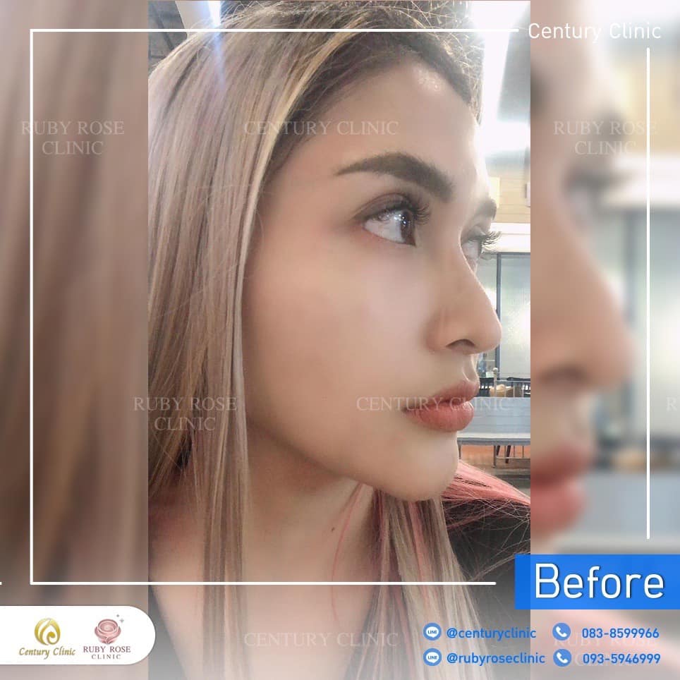 รีวิว เสริมจมูก #482 , Century Clinic Thailand Century-รีวิว-เสริมจมูก 2#482