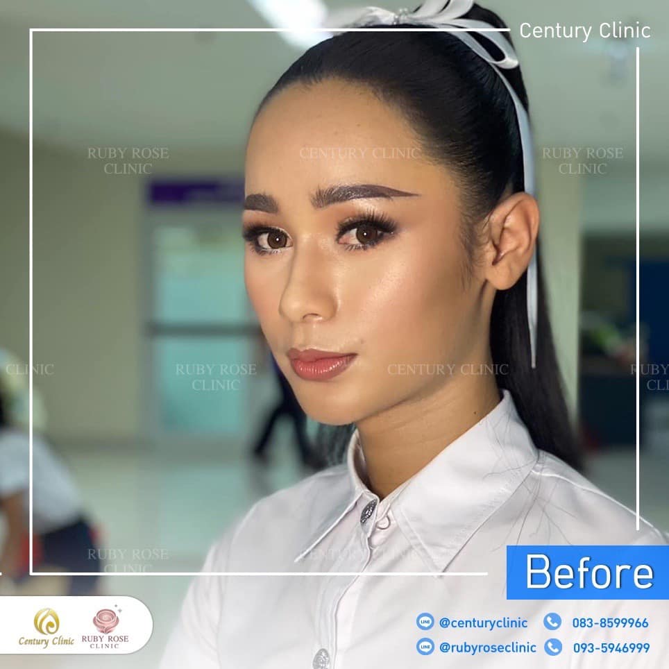 Century-รีวิว-เสริมจมูก 2#501
