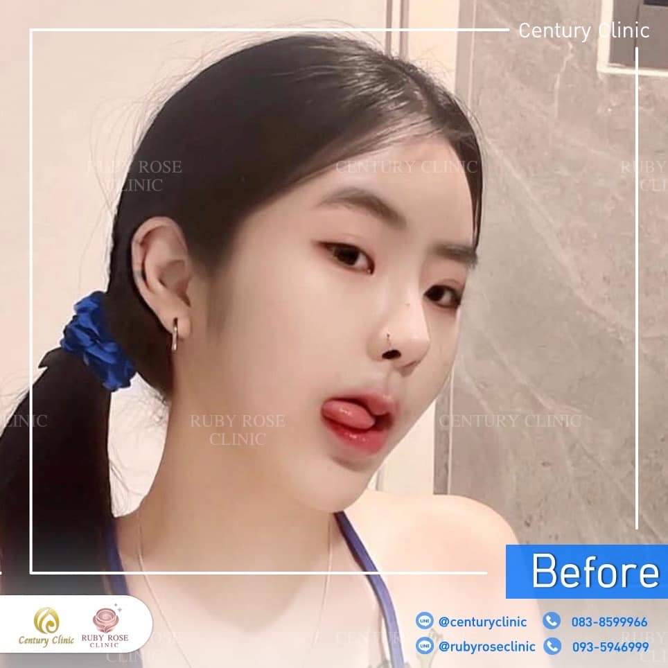Century-รีวิว-เสริมจมูก 2#502