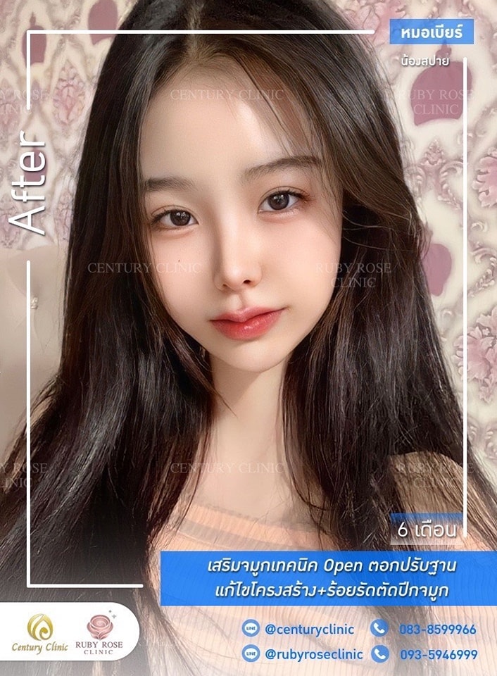 Century-รีวิว-เสริมจมูก #433