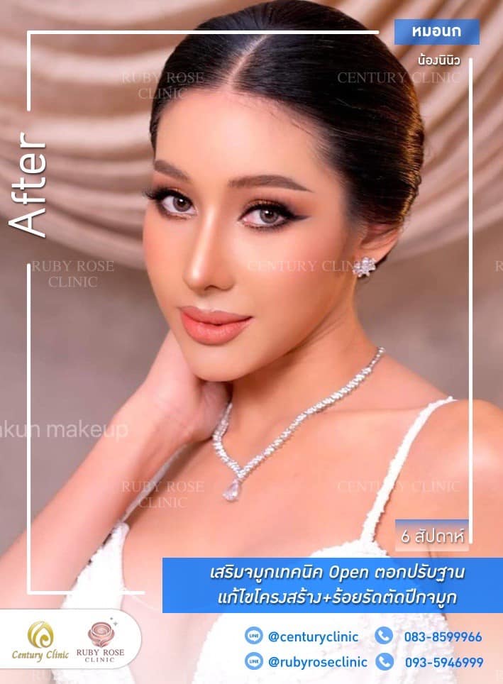 รีวิว เสริมจมูก #441 , Century Clinic Thailand Century-รีวิว-เสริมจมูก #441