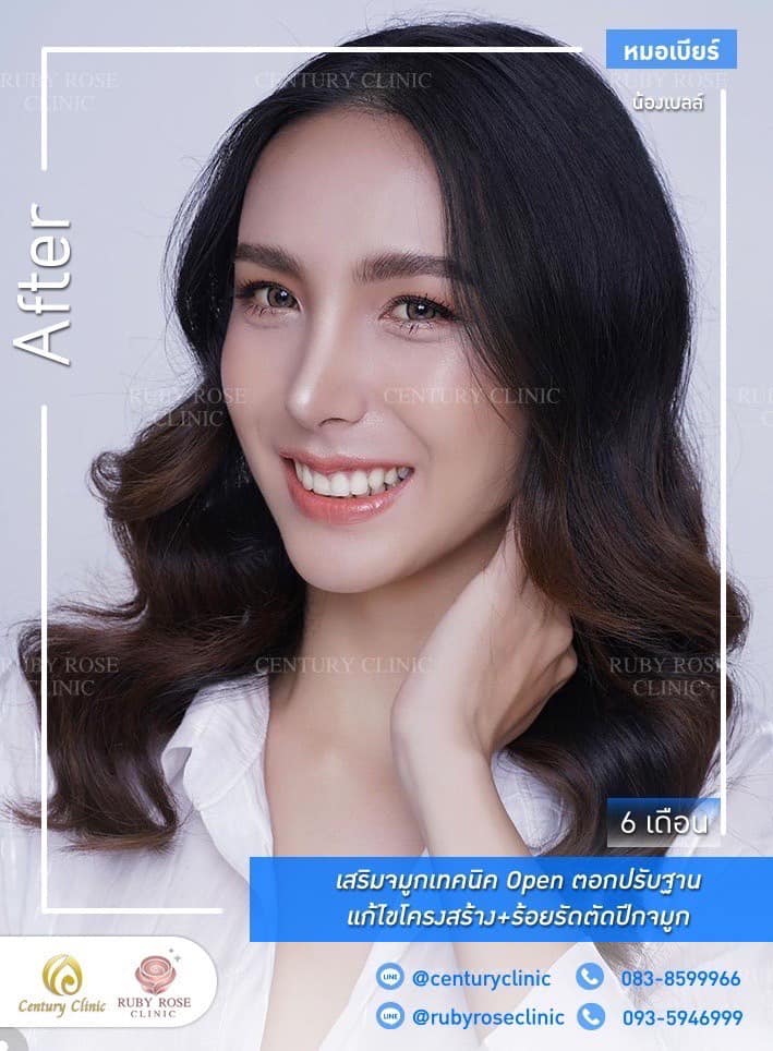 Century-รีวิว-เสริมจมูก #443