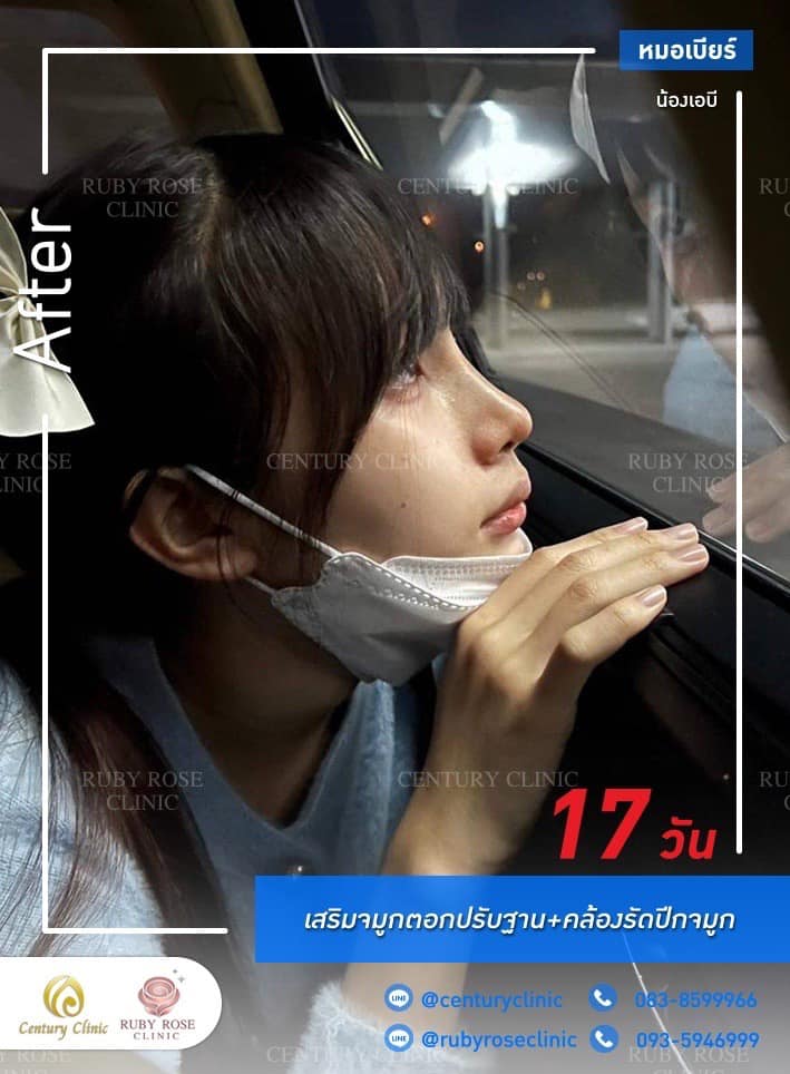 Century-รีวิว-เสริมจมูก #453