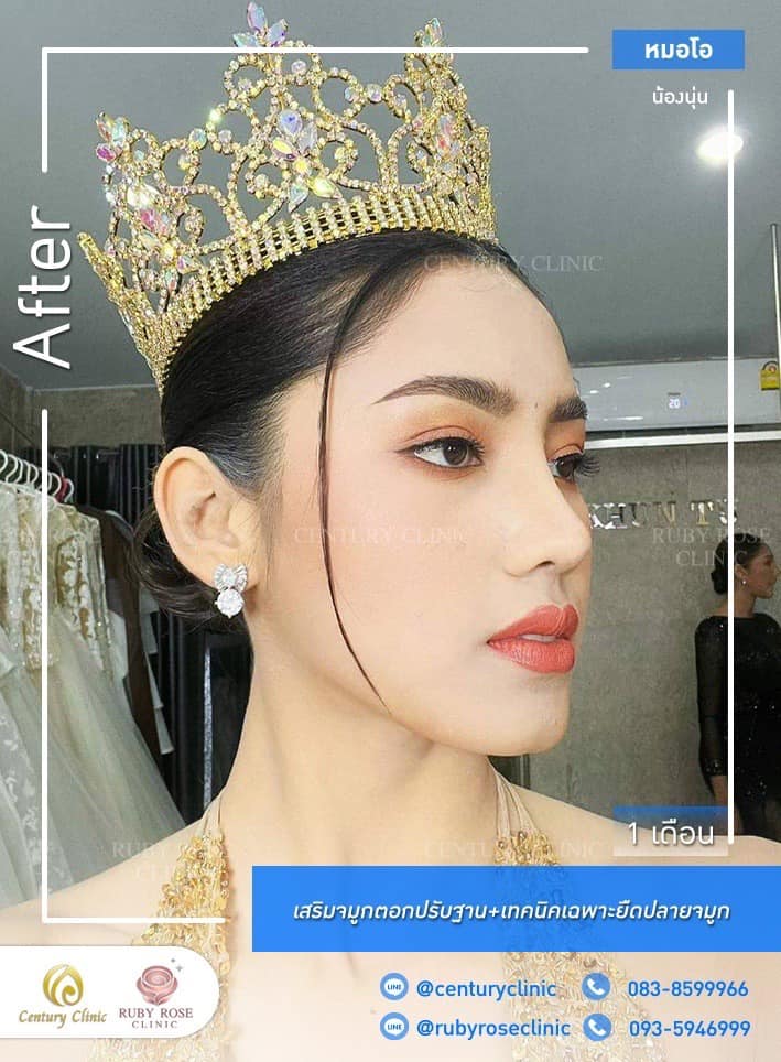 Century-รีวิว-เสริมจมูก #458