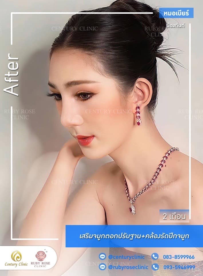Century-รีวิว-เสริมจมูก #459
