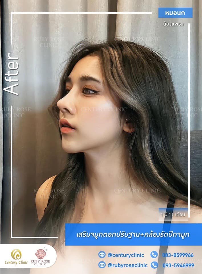 รีวิว เสริมจมูก #462 , Century Clinic Thailand Century-รีวิว-เสริมจมูก #462