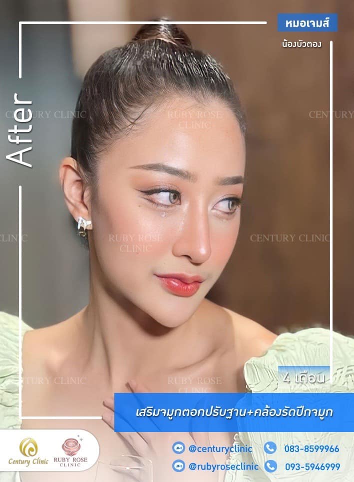รีวิว เสริมจมูก #466 , Century Clinic Thailand Century-รีวิว-เสริมจมูก #466