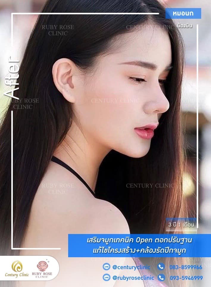 Century-รีวิว-เสริมจมูก #467