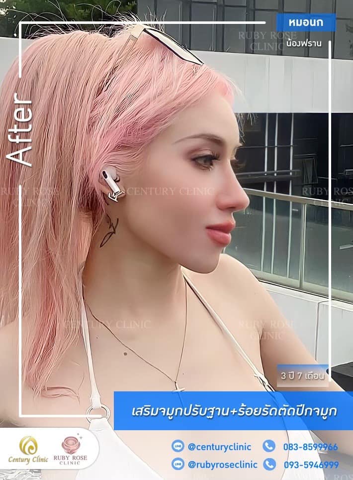Century-รีวิว-เสริมจมูก #471