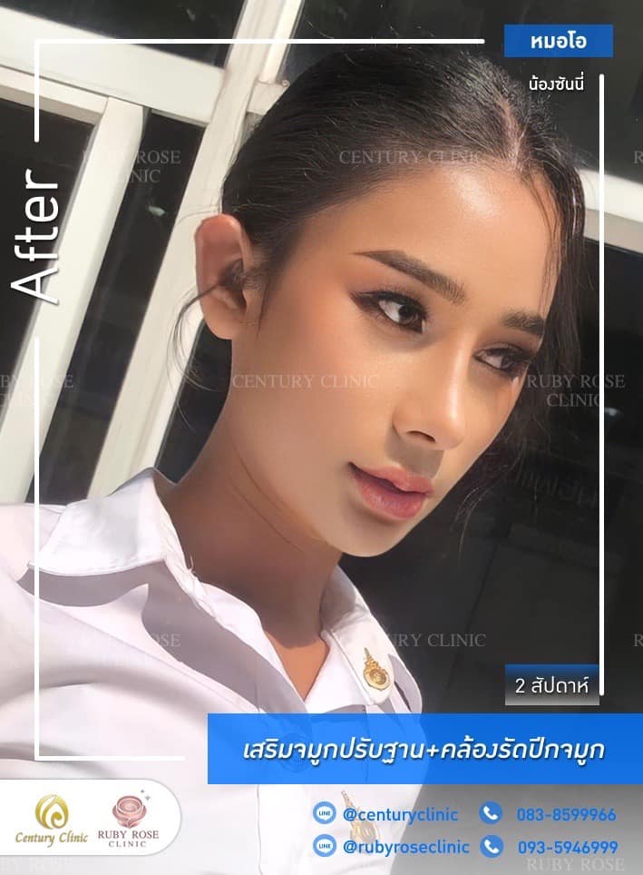 Century-รีวิว-เสริมจมูก #477