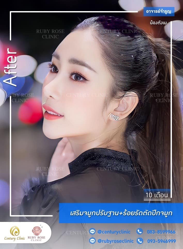 Century-รีวิว-เสริมจมูก #479