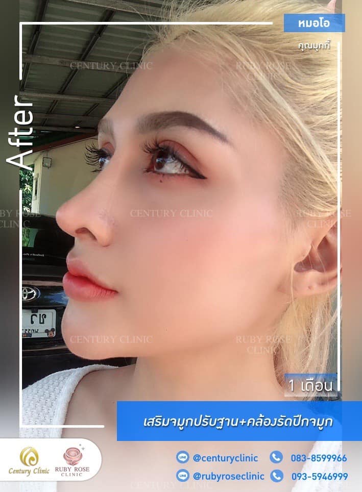 รีวิว เสริมจมูก #482 , Century Clinic Thailand Century-รีวิว-เสริมจมูก #482