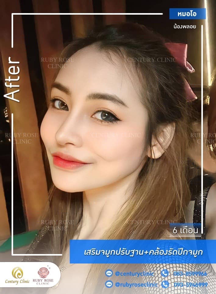 Century-รีวิว-เสริมจมูก #497