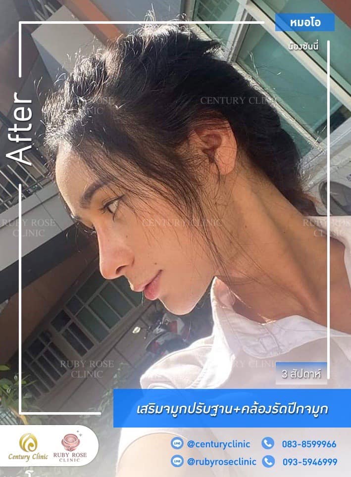 Century-รีวิว-เสริมจมูก #501