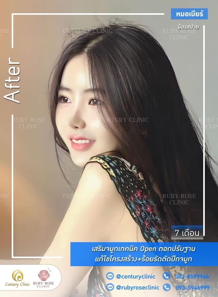 Century-รีวิว-เสริมจมูก #502