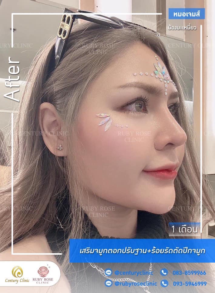 รีวิว เสริมจมูก #504 , Century Clinic Thailand Century-รีวิว-เสริมจมูก #504
