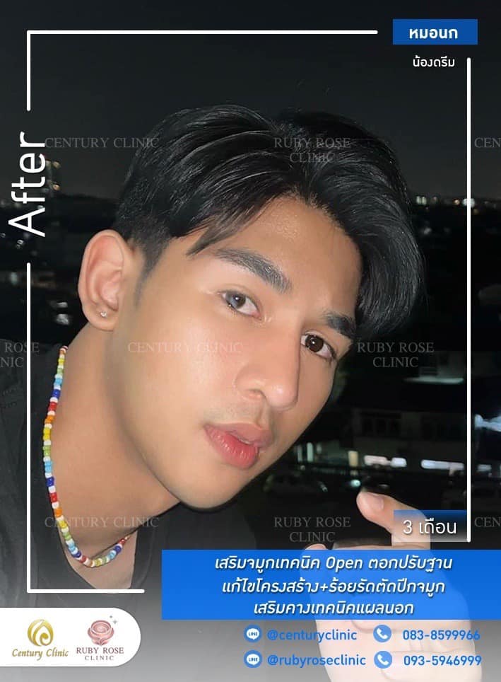 รีวิว เสริมจมูก #495 , Century Clinic Thailand Century-รีวิว-เสริมจมูก-คาง 1#495
