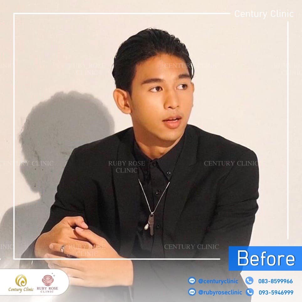 รีวิว เสริมจมูก #495 , Century Clinic Thailand Century-รีวิว-เสริมจมูก-คาง 2#495