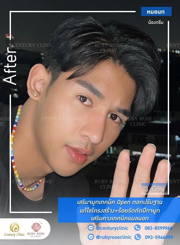 Century-รีวิว-เสริมจมูก-คาง #495