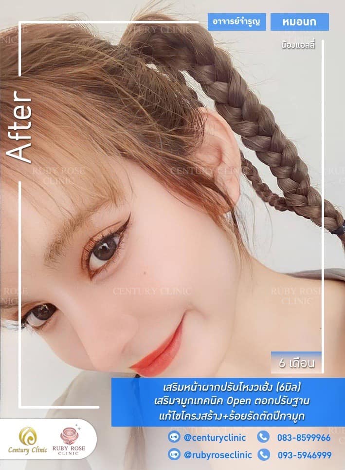 Century-รีวิว-เสริมจมูก-หน้าผาก 1#498