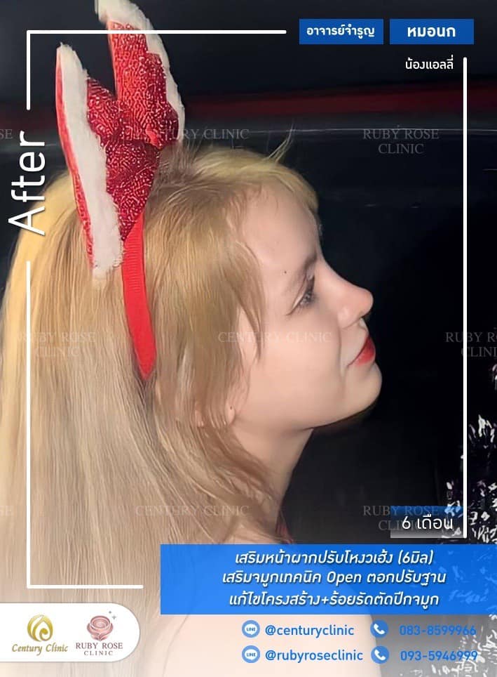 Century-รีวิว-เสริมจมูก-หน้าผาก #498