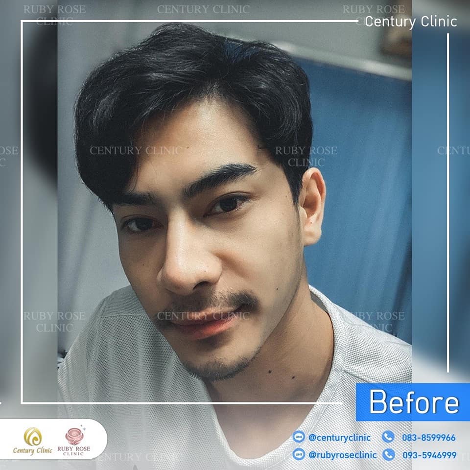 รีวิว แก้จมูก #422 , Century Clinic Thailand Century-รีวิว-แก้จมูก 1#422