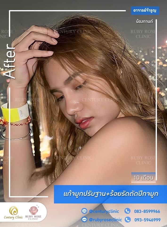 รีวิว แก้จมูก #423 , Century Clinic Thailand Century-รีวิว-แก้จมูก 1#423