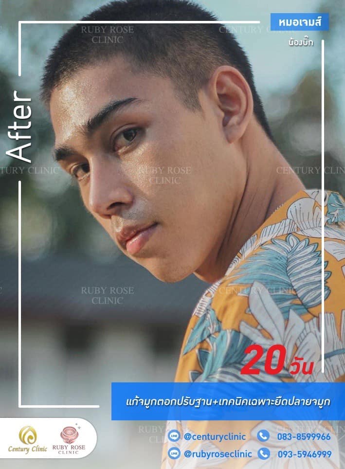 Century-รีวิว-แก้จมูก 1#424