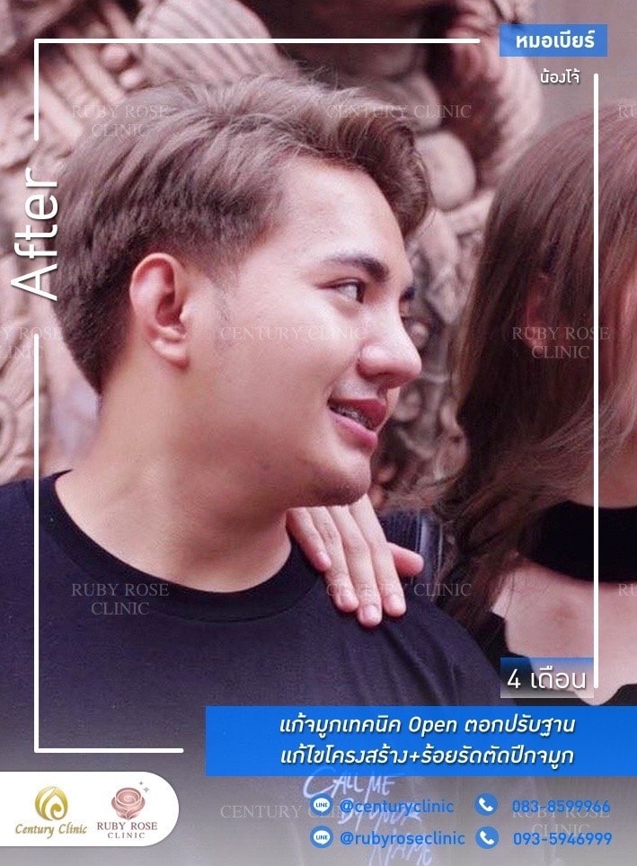 รีวิว แก้จมูก #428 , Century Clinic Thailand Century-รีวิว-แก้จมูก 1#428