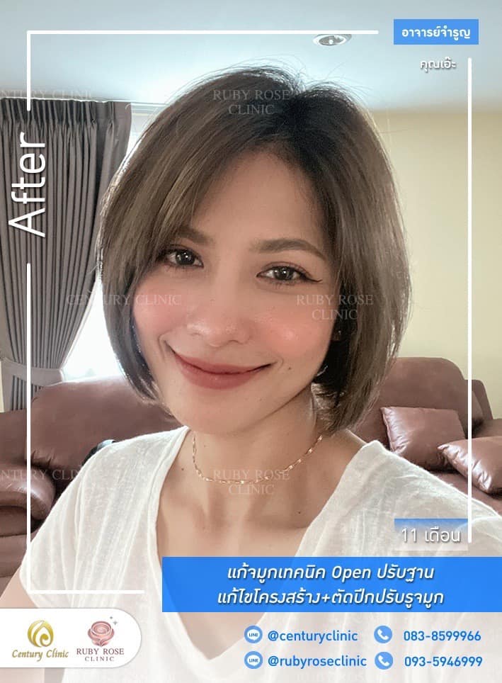Century-รีวิว-แก้จมูก 1#434