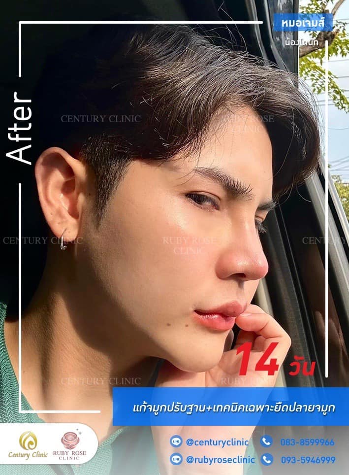 Century-รีวิว-แก้จมูก 1#435