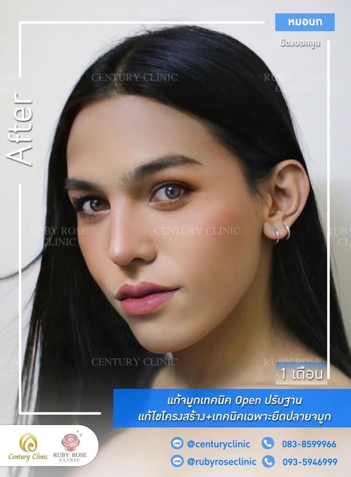รีวิว แก้จมูก #436 , Century Clinic Thailand Century-รีวิว-แก้จมูก 1#436