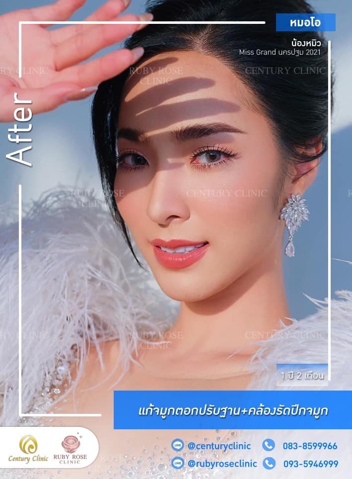 รีวิว แก้จมูก #437 , Century Clinic Thailand Century-รีวิว-แก้จมูก 1#437