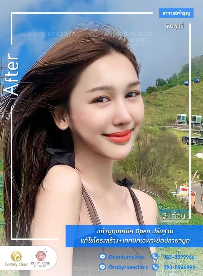 Century-รีวิว-แก้จมูก 1#439