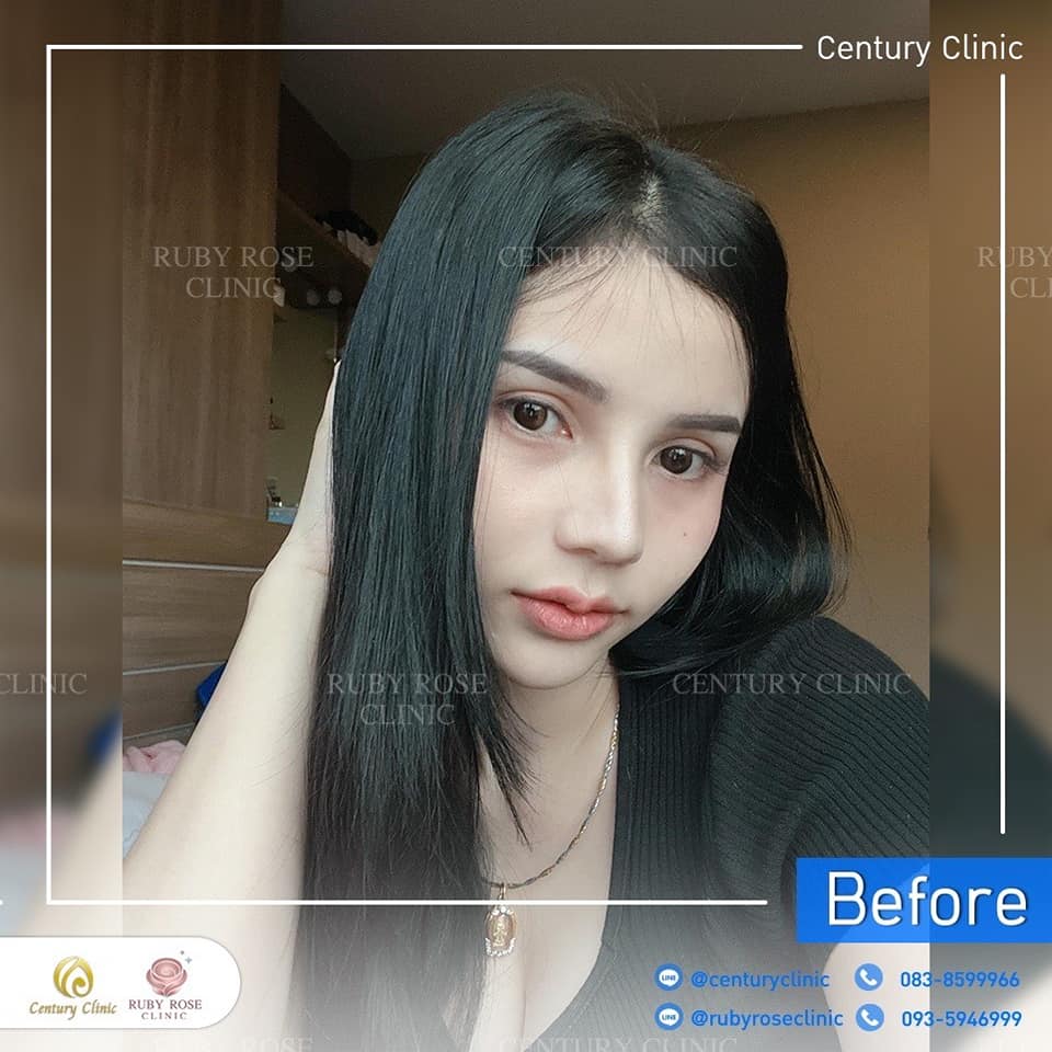 รีวิว แก้จมูก #442 , Century Clinic Thailand Century-รีวิว-แก้จมูก 1#442