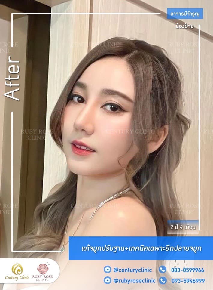 Century-รีวิว-แก้จมูก 1#444