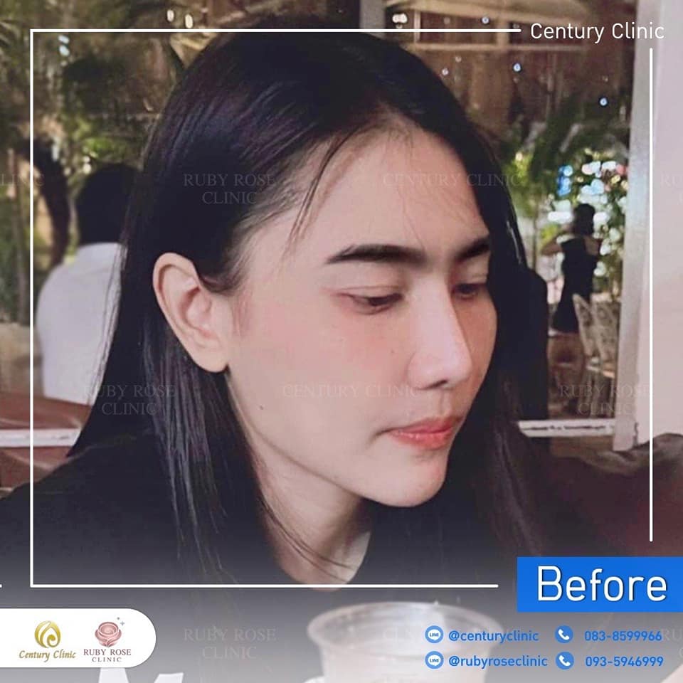 Century-รีวิว-แก้จมูก 1#445