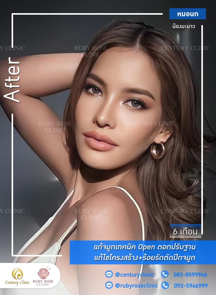 Century-รีวิว-แก้จมูก 1#446