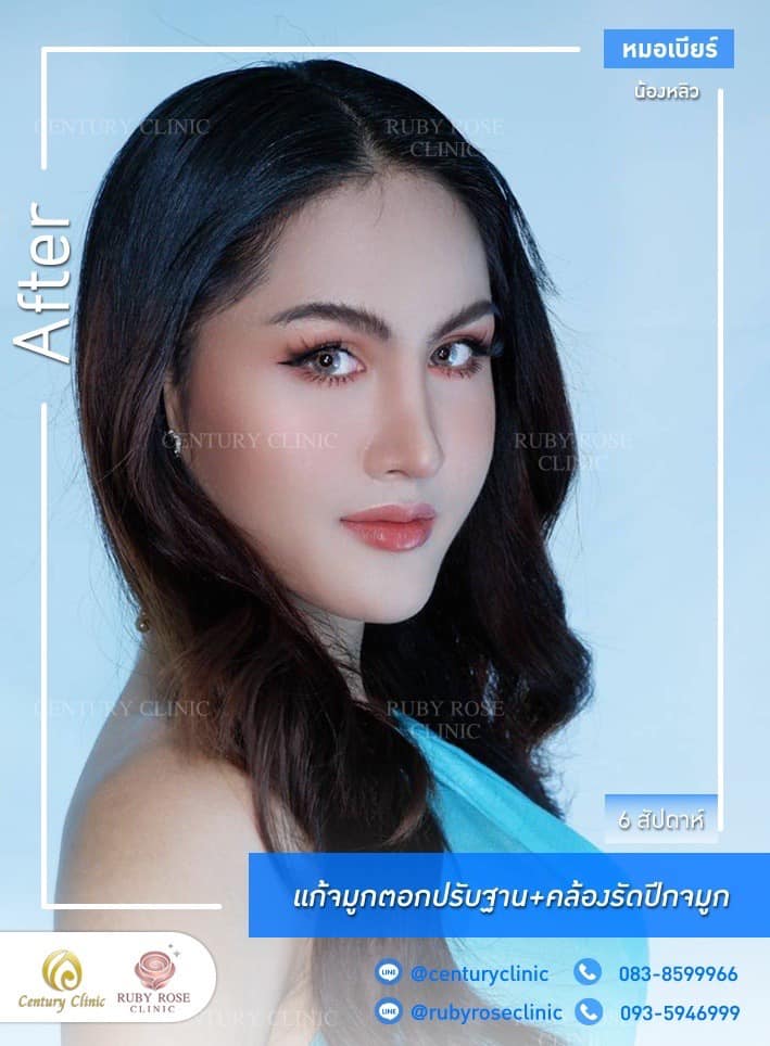 รีวิว แก้จมูก #448 , Century Clinic Thailand Century-รีวิว-แก้จมูก 1#448