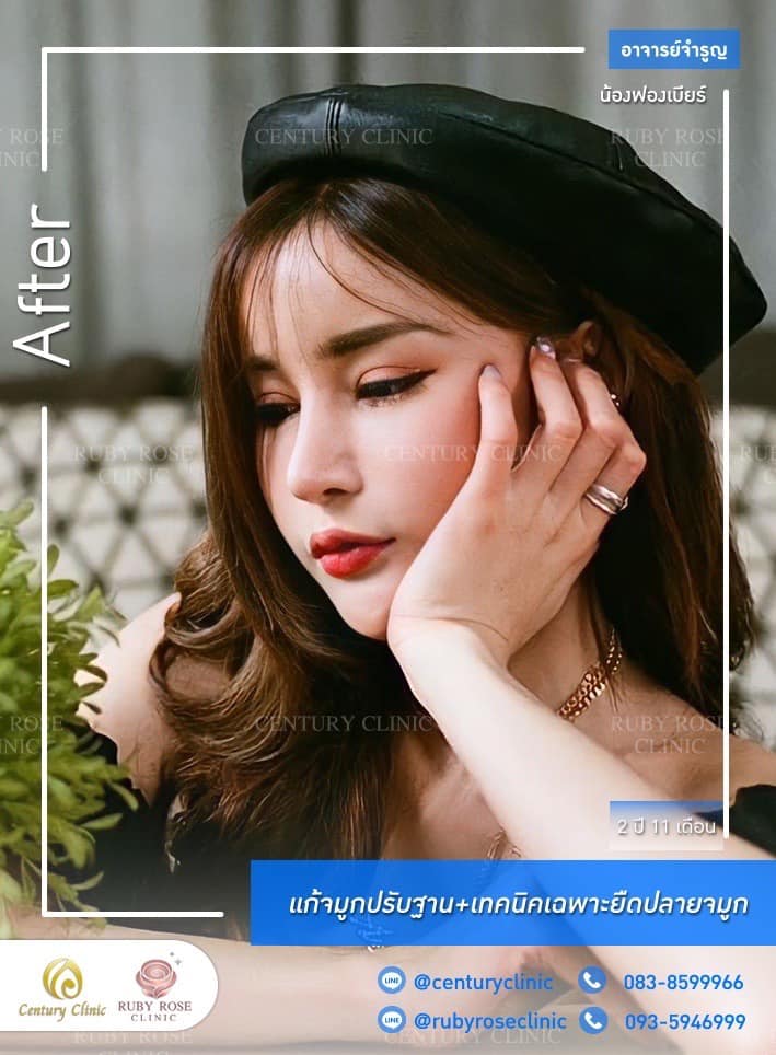 Century-รีวิว-แก้จมูก 1#449